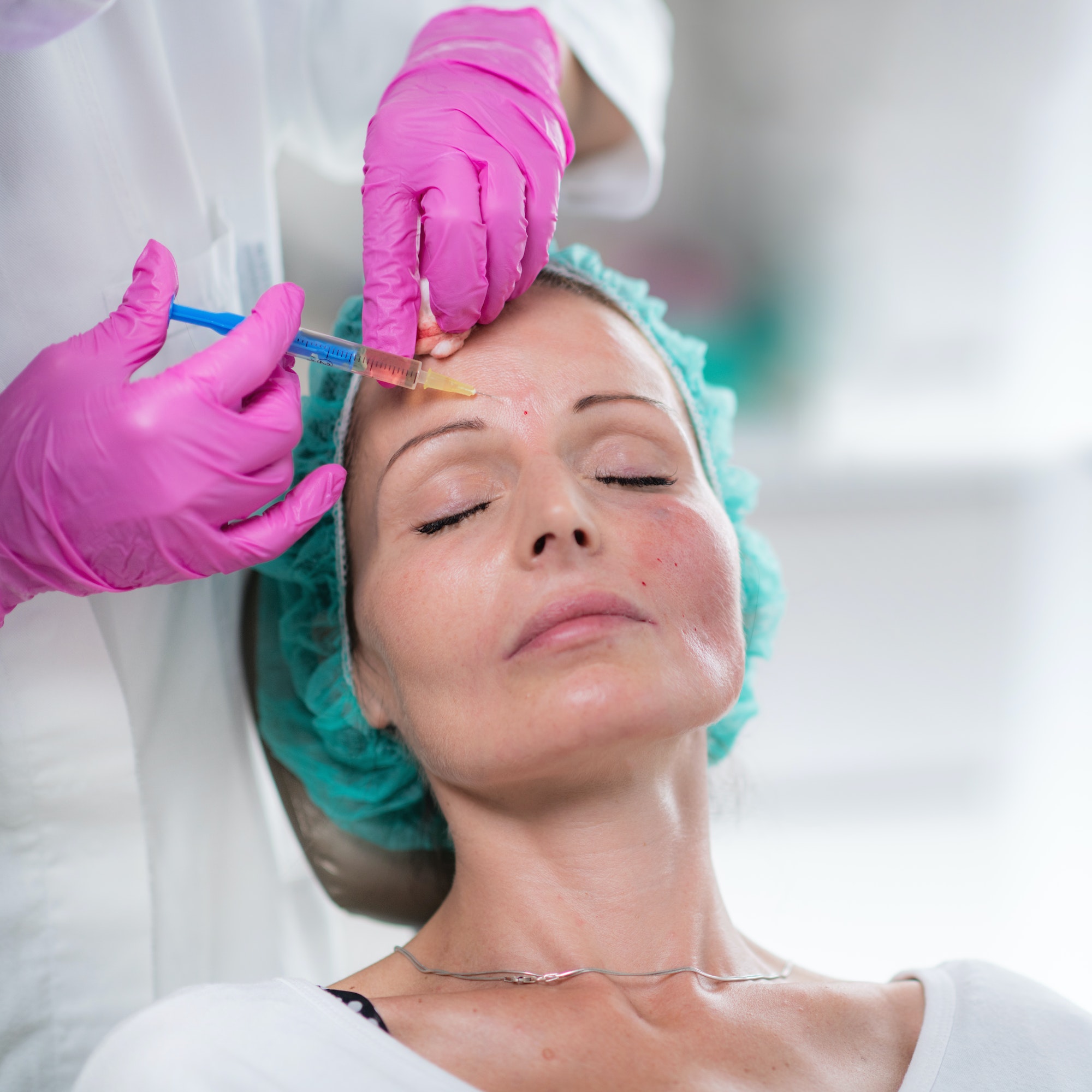 Hyaluronic Acid Injection Fillers for Forehead